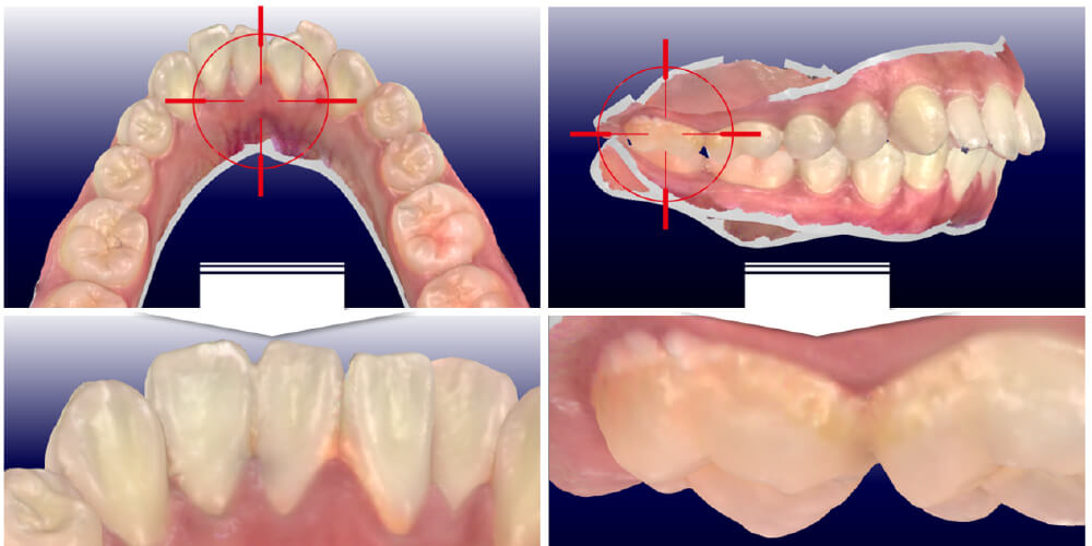 歯科用CT